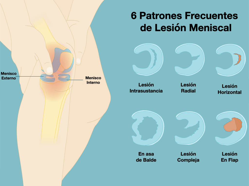Lesion meniscal deals